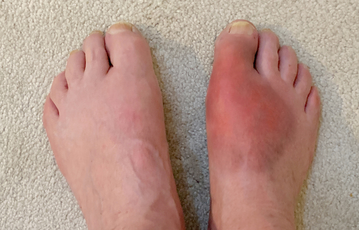 gout