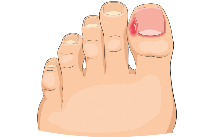 bacterial nail infection.jpg