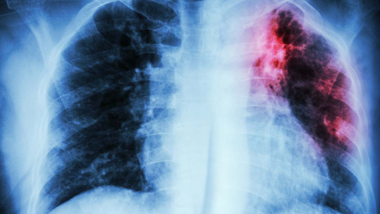 tuberculosis-summary