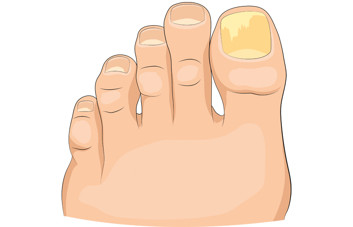 fungal nail infection.jpg